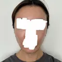 ボトックス（エラ・小顔） / ヒアルロン酸注入（額） / ヒアルロン酸注入（頬） / デンシティ フィラークリニック 新宿院 DAY 1 サムネイル用