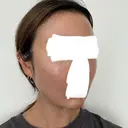 ボトックス（エラ・小顔） / ヒアルロン酸注入（額） / ヒアルロン酸注入（頬） / デンシティ フィラークリニック 新宿院 DAY 1 サムネイル用