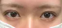 二重埋没 EMMA CLINIC（エマクリニック） AFTER サムネイル用