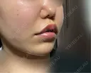 糸リフト / ボトックス（あご） / ボトックス（眉間） / ボトックス（目尻） / ボトックス（額） TCB東京中央美容外科 高崎院 DAY 60 サムネイル用