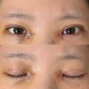 二重埋没 / 目頭切開 / 上まぶたの脂肪取り / ヒアルロン酸注入（涙袋） アリエル美容クリニック 郡山院 DAY 6 サムネイル用