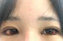 二重埋没 / 目頭切開 / 目尻切開 / タレ目形成・グラマラスライン（切開） ziz CLINIC DAY 3 サムネイル用