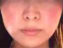 その他（輪郭） / 医療痩身（顔） / その他（肌） / RF（高周波）たるみ治療 / オンダリフト ライブリークリニック 船橋院 DAY 0 サムネイル用