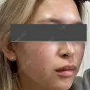 ピーリング（ニキビ・毛穴） / 光治療（フォトフェイシャルなど） 大美会クリニック 梅田院 DAY 0 サムネイル用