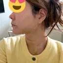 糸リフト / 脂肪吸引（顔） 4Dクリニック DAY 14 サムネイル用