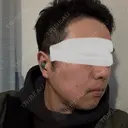 脂肪溶解注射（顔） 上野注入クリニック DAY 4 サムネイル用
