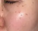 ピコスポット APスキンクリニック銀座 DAY 8 サムネイル用