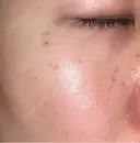 ピコスポット APスキンクリニック銀座 DAY 8 サムネイル用