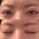 二重埋没 形成外科と美容外科のクリニック池袋 AFTER サムネイル用