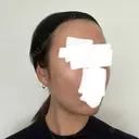 ボトックス（エラ・小顔） / ヒアルロン酸注入（額） / ヒアルロン酸注入（頬） / デンシティ フィラークリニック 新宿院 DAY 3 サムネイル用