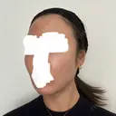 ボトックス（エラ・小顔） / ヒアルロン酸注入（額） / ヒアルロン酸注入（頬） / デンシティ フィラークリニック 新宿院 DAY 3 サムネイル用