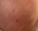 ピーリング（ハリ・ツヤ） / ルメッカ 小倉美容外科/美容皮膚科 ビラビューティークリニック DAY 6 サムネイル用