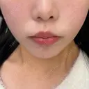 糸リフト / クマ治療 / 脂肪吸引（顔） / 下まぶたたるみ取り / 下まぶたの脂肪取り / ジョールファット除去 / 脂肪注入（目の下） / 脂肪吸引注射（顔） / ヒアルロン酸注入（あご） / ボトックス（エラ・小顔） SEA CLINIC（シークリニック） DAY 23 サムネイル用