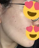 美肌レーザー / LDM・インテンスウルトラ ライズワン美容皮膚科クリニック AFTER サムネイル用