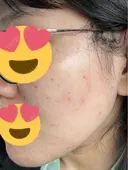 美肌レーザー / LDM・インテンスウルトラ ライズワン美容皮膚科クリニック DAY 19 サムネイル用