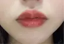 ヒアルロン酸注入（唇） 目白ホワイトクリニック AFTER サムネイル用