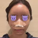 鼻尖形成（切開） / 軟骨移植 / 脂肪注入（額） / 鼻翼基部形成（貴族手術） eクリニック 福岡院 DAY 1 サムネイル用