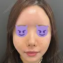 鼻尖形成（切開） / 軟骨移植 / 脂肪注入（額） / 鼻翼基部形成（貴族手術） eクリニック 福岡院 DAY 7 サムネイル用