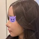鼻尖形成（切開） / 軟骨移植 / 脂肪注入（額） / 鼻翼基部形成（貴族手術） eクリニック 福岡院 DAY 9 サムネイル用
