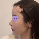 鼻尖形成（切開） / 軟骨移植 / 脂肪注入（額） / 鼻翼基部形成（貴族手術） eクリニック 福岡院 DAY 13 サムネイル用