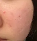 ピーリング（ハリ・ツヤ） ジュエルクリニック 恵比寿院 DAY 6 サムネイル用