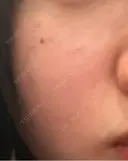 ピーリング（ハリ・ツヤ） ジュエルクリニック 恵比寿院 DAY 6 サムネイル用