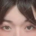 二重切開 / 眼瞼下垂（切開） 広島プルミエクリニック DAY 92 サムネイル用