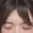 二重切開 / 眼瞼下垂（切開） 広島プルミエクリニック DAY 92 サムネイル用