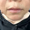 ヒアルロン酸注入（あご） / ヒアルロン酸注入（鼻翼基部） ルラ美容クリニック 郡山院 DAY 9 サムネイル用
