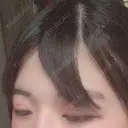 二重切開 / 眼瞼下垂（切開） 広島プルミエクリニック DAY 92 サムネイル用