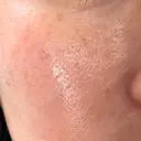 ダーマペン LE CLINIC AFTER サムネイル用