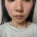 イオン導入 / 毛穴洗浄（ハイドラフェイシャルなど） / ルメッカ ルラ美容クリニック 岡山院 DAY 21 サムネイル用