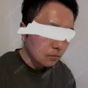 脂肪溶解注射（顔） 上野注入クリニック DAY 7 サムネイル用