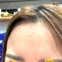 ボトックス（額） ルラ美容クリニック 郡山院 AFTER サムネイル用