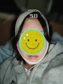 糸リフト / 脂肪吸引（顔） Days Beauty Clinic 新宿院 DAY 0 サムネイル用