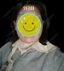 糸リフト / 脂肪吸引（顔） Days Beauty Clinic 新宿院 DAY 2 サムネイル用