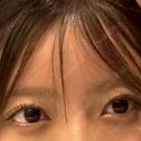 ヒアルロン酸注入（涙袋） eクリニック 横浜みなとみらい院 AFTER サムネイル用