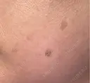 ピーリング（ハリ・ツヤ） / ルメッカ 小倉美容外科/美容皮膚科 ビラビューティークリニック DAY 8 サムネイル用