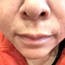 ヒアルロン酸注入（あご） / ヒアルロン酸注入（鼻翼基部） ルラ美容クリニック 郡山院 DAY 11 サムネイル用
