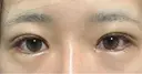 二重埋没 / 目頭切開 / 目尻切開 / タレ目形成・グラマラスライン（切開） ziz CLINIC DAY 8 サムネイル用