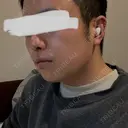 脂肪溶解注射（顔） 上野注入クリニック DAY 8 サムネイル用