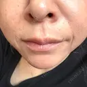 ヒアルロン酸注入（あご） / ヒアルロン酸注入（鼻翼基部） ルラ美容クリニック 郡山院 AFTER サムネイル用