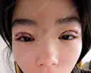 眼瞼下垂（切開） BIANCA銀座 DAY 0 サムネイル用