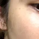 ルメッカ 栄美容クリニック 栄院 AFTER サムネイル用