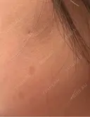 ピーリング（ハリ・ツヤ） / ルメッカ 小倉美容外科/美容皮膚科 ビラビューティークリニック DAY 10 サムネイル用