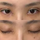 二重埋没 / 目頭切開 / 上まぶたの脂肪取り アリエル美容クリニック 郡山院 DAY 7 サムネイル用