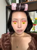 隆鼻術 / 鼻尖形成（切開） / 鼻中隔延長（切開） / 小鼻縮小（切開） / 軟骨移植 / 鼻修正 / 鼻孔縁下降 シンデレラ＆ダヴィンチクリニック AFTER サムネイル用