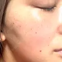 ピーリング（ニキビ・毛穴） / 光治療（フォトフェイシャルなど） 大美会クリニック 梅田院 AFTER サムネイル用