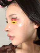 隆鼻術 / 鼻尖形成（切開） / 鼻中隔延長（切開） / 小鼻縮小（切開） / 軟骨移植 / 鼻修正 / 鼻孔縁下降 シンデレラ＆ダヴィンチクリニック DAY 65 サムネイル用