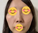 鼻尖形成（切開） / 鼻中隔延長（切開） / 軟骨移植 / 眉間プロテーゼ eクリニック 福岡院 AFTER サムネイル用